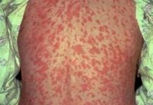 Canada no longer holds measles elimination status